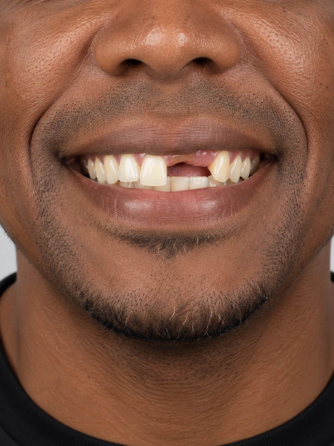 Antes do tratamento de implantes dentários, mostrando apenas a região da boca.