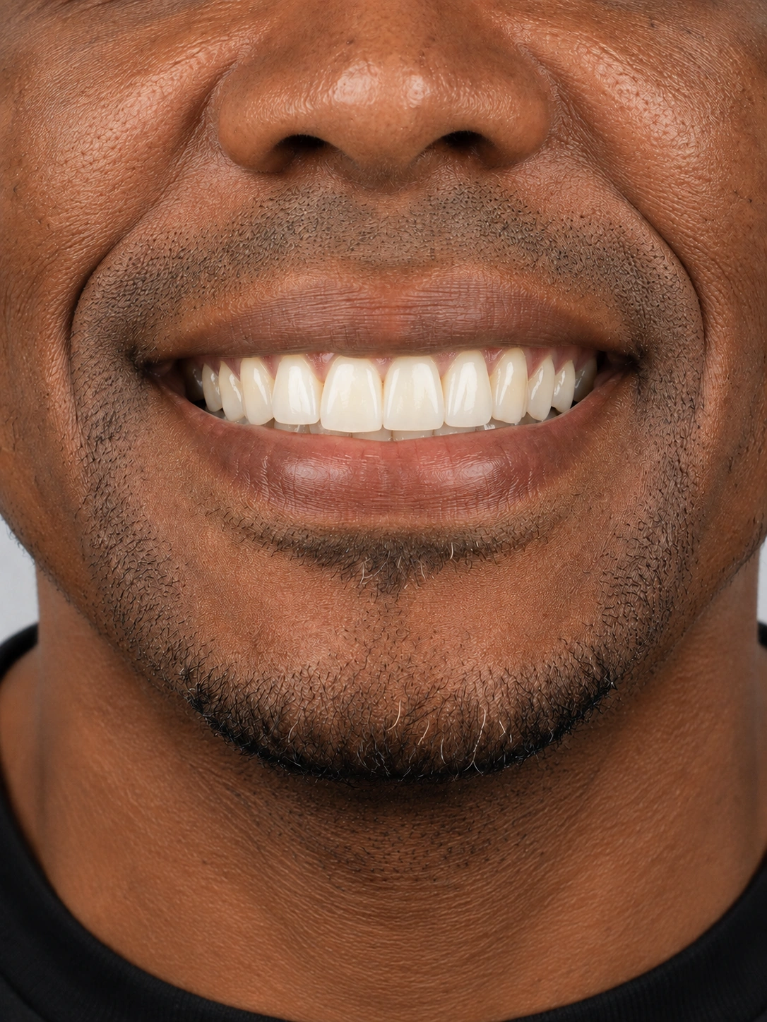 Depois do tratamento de implantes dentários, mostrando apenas a região da boca.