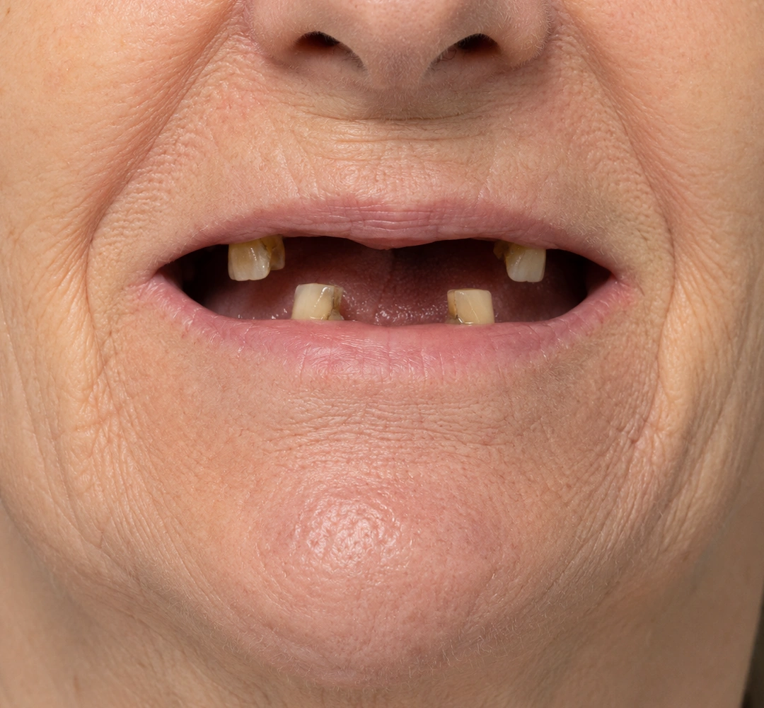Antes do tratamento de próteses dentárias, mostrando apenas a região da boca.
