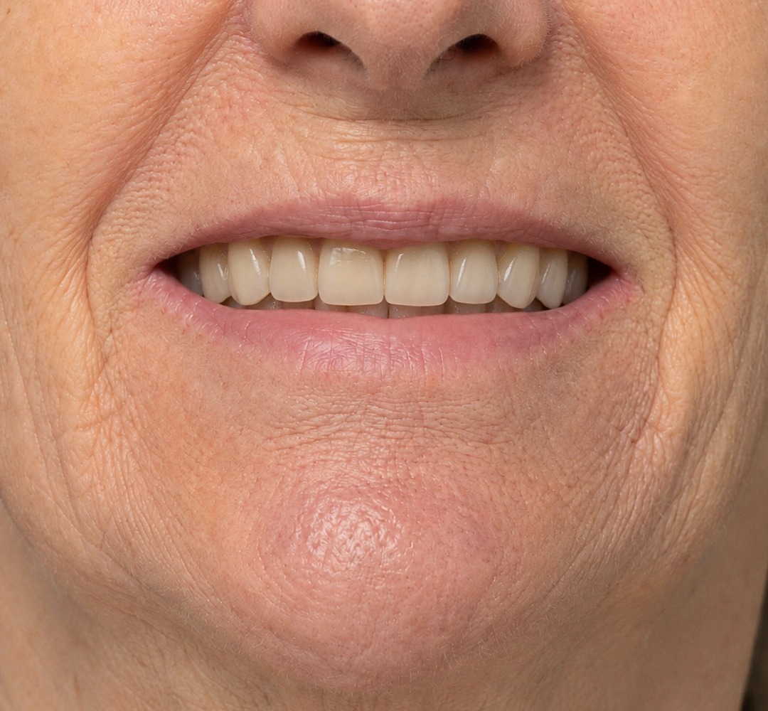 Depois do tratamento de próteses dentárias, mostrando apenas a região da boca.